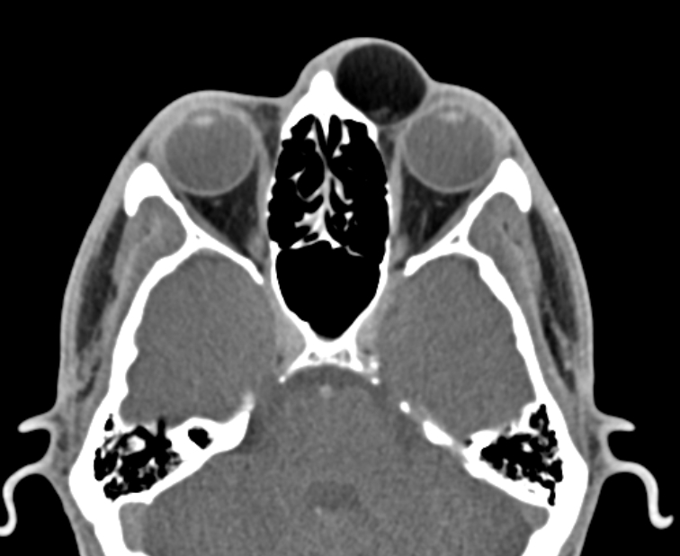 Internal angular dermoid cyst | Image | Radiopaedia.org