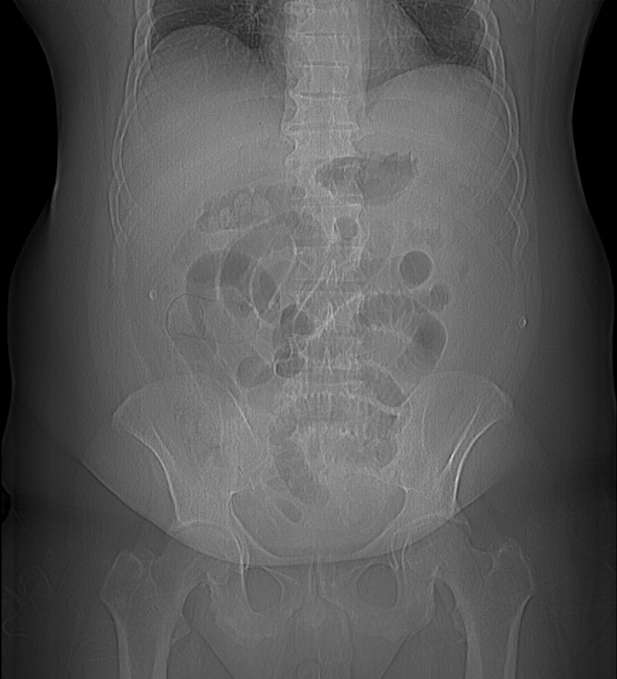 Small bowel ischemia Image