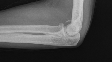 Intra-articular fragments | Radiology Reference Article | Radiopaedia.org