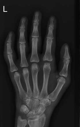 Combined avulsions of central and terminal slips of finger extensor ...