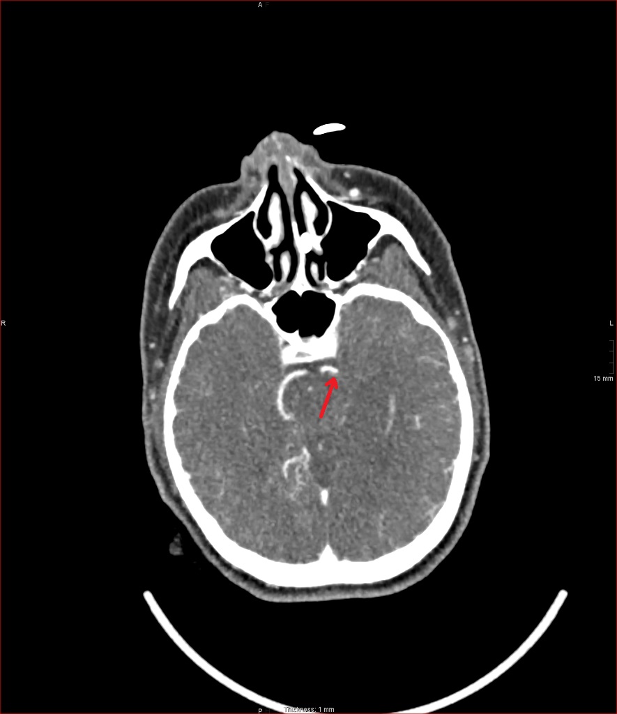 Basilar And Posterior Cerebral Artery Hyperdense Clots Image