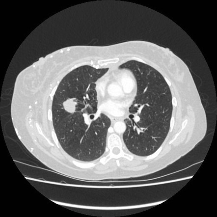 Hepatic pseudolesion due to superior vena cava obstruction | Image ...