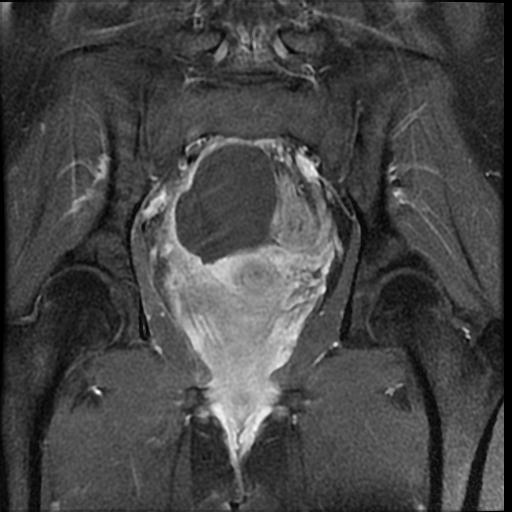 Ovarian torsion | Image | Radiopaedia.org