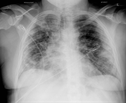 COVID-19 pneumonia with superadded bacterial infection | Radiology Case ...