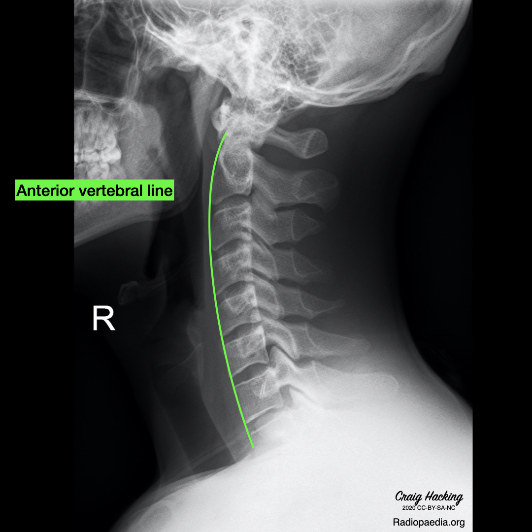 Cervical spine lines | Image | Radiopaedia.org