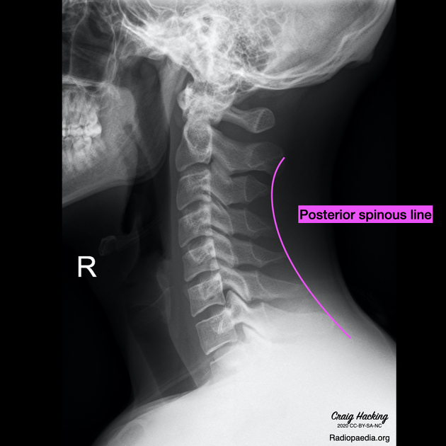 Cervical Spine Anatomy & Clinical Significances - Anatomy Info