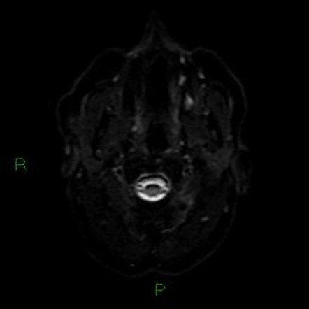 Posterior inferior cerebellar artery territory infarct | Image ...