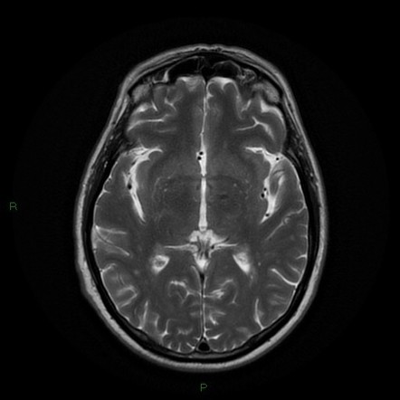 Posterior inferior cerebellar artery territory infarct | Image ...