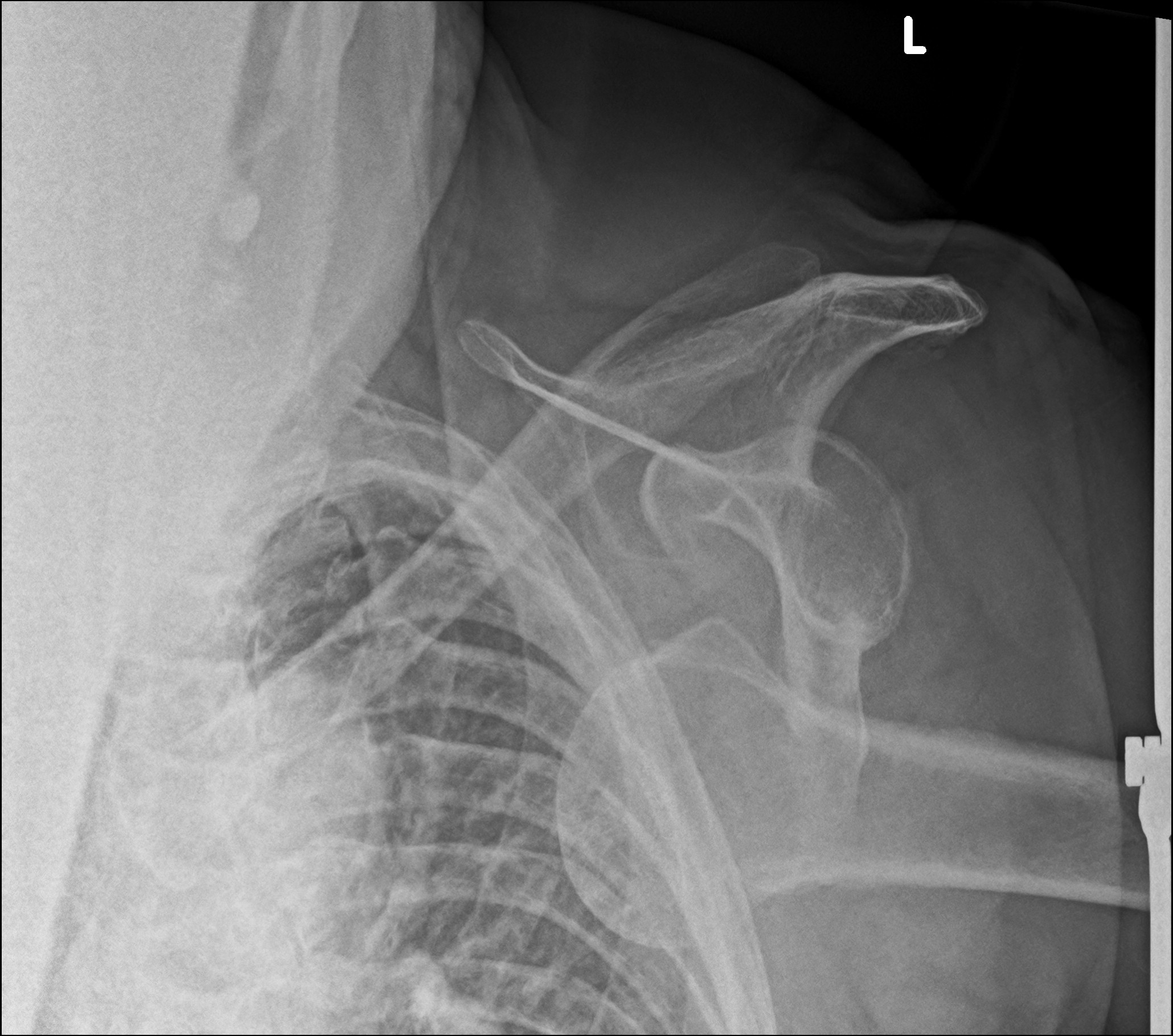 Bilateral Shoulder Dislocation Image