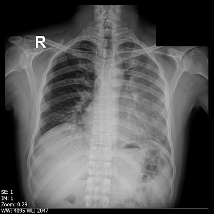 Luftsichel sign | Radiology Case | Radiopaedia.org