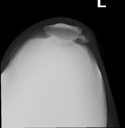 Multipartite patella | Image | Radiopaedia.org