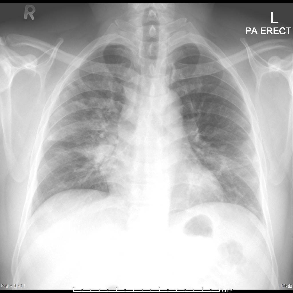 Covid 19 Pneumonia Radiology Case Radiopaedia Org