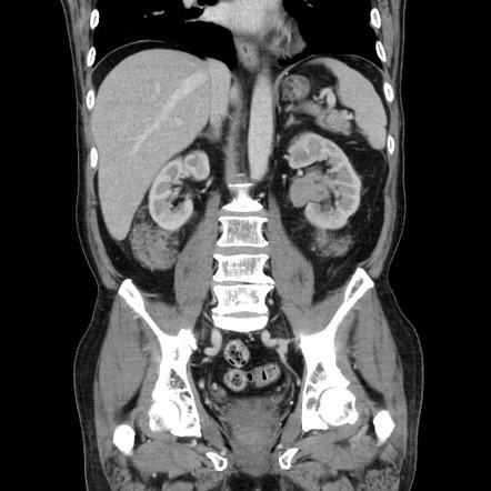 Perirenal plasmacytomas | Image | Radiopaedia.org