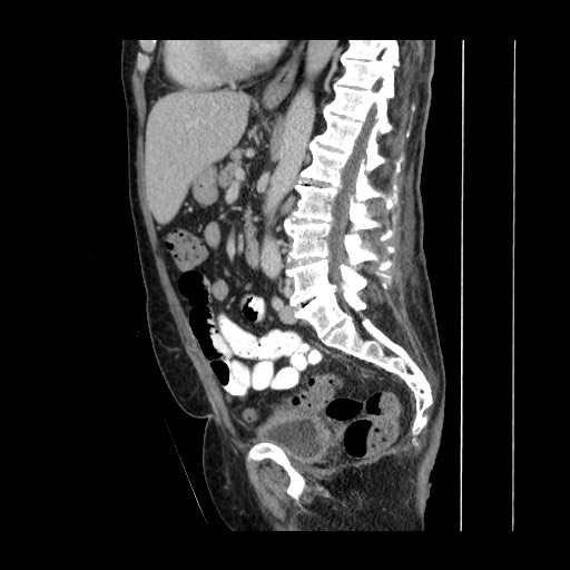 File:series With Large Renal Abscess, Drainage, And Resolution 