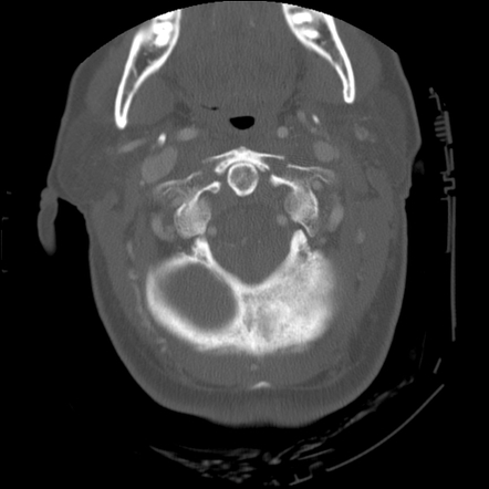 C1 anterior arch (plough) fracture - type 1 | Radiology Case ...