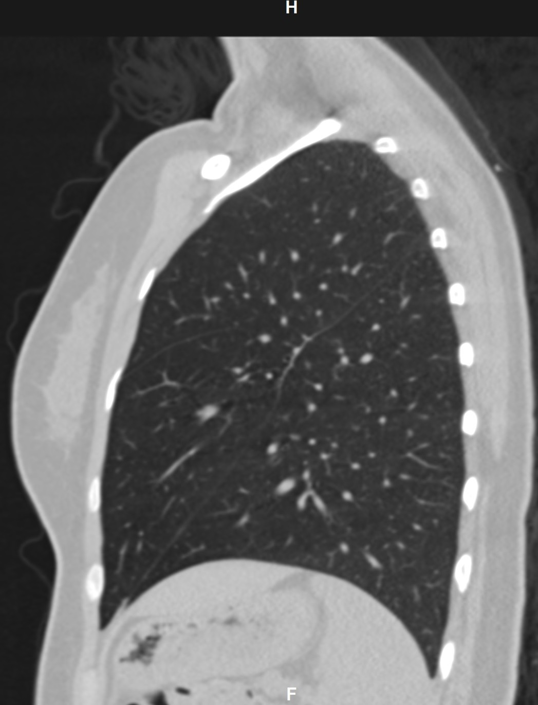 Accessory lung fissures | Image | Radiopaedia.org