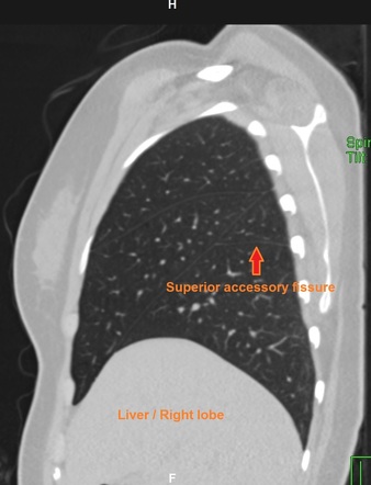 Superior accessory fissure | Radiology Reference Article | Radiopaedia.org