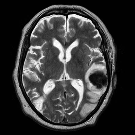 cerebral artery stroke case study