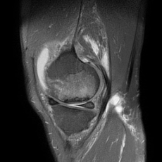 Subchondral Insufficiency Fracture Of The Knee | Image | Radiopaedia.org