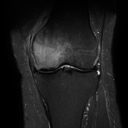 Subchondral insufficiency fracture of the knee | Radiology Case ...