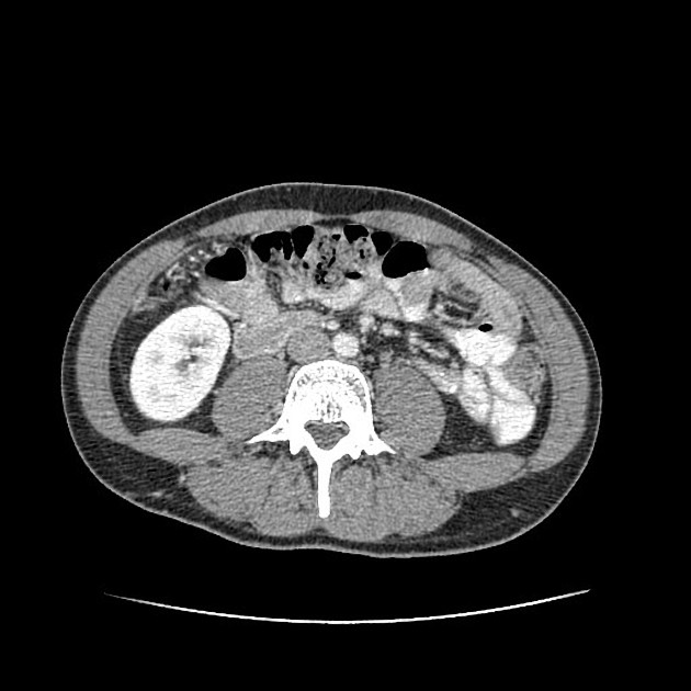 Featured image of post Appendix Mucocele Radiopaedia Overdistension of the appendix with mucous 2 to luminal obstruction by fecalith or foreign body carcinoid or endometriosis