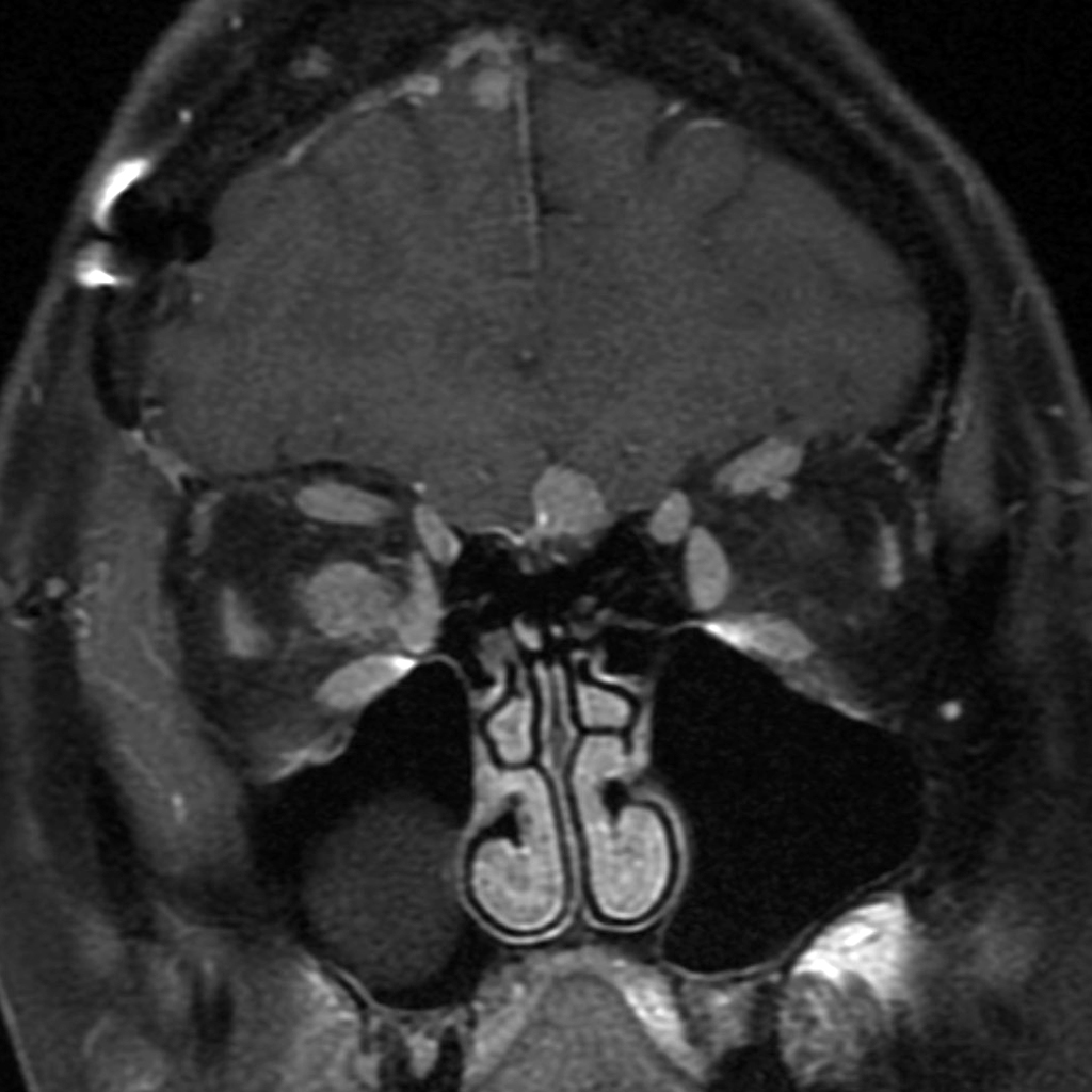 Мрт глазного нерва. Глиома зрительного нерва мрт. Менингиома доброкачественная. Менингиома экзофтальм. Менингиома зрительного нерва кт.