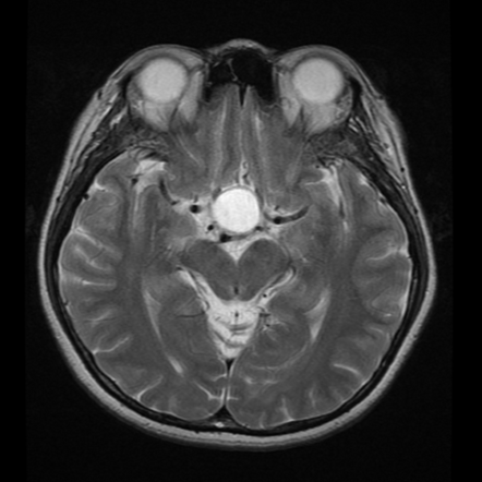 Rathke's cleft cyst | Image | Radiopaedia.org