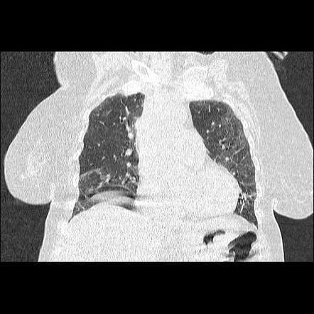 COVID-19 pneumonia | Image | Radiopaedia.org