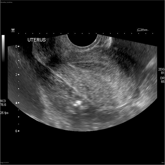 ruptured ectopic pregnancy ultrasound