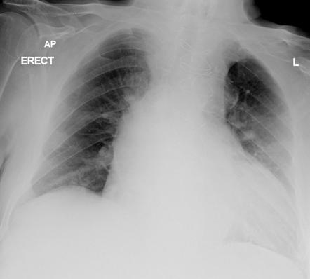 Aortic dissection - Stanford type A | Radiology Case | Radiopaedia.org