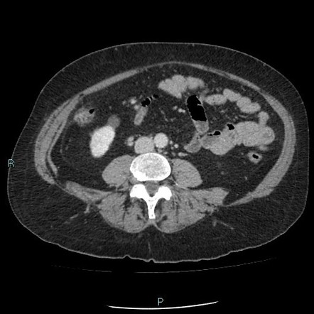 Large Bladder Calculus | Image | Radiopaedia.org