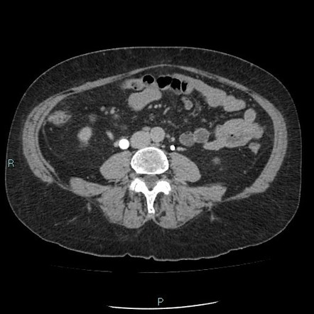 Large Bladder Calculus | Image | Radiopaedia.org