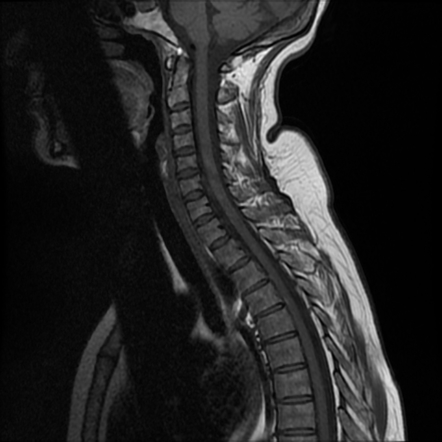 Subacute combined degeneration of the cord | Image | Radiopaedia.org