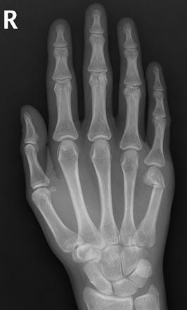 Boxer Fracture Radiology Case Radiopaedia Org