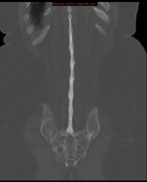 Ankylosing spondylitis - with dagger sign | Image | Radiopaedia.org