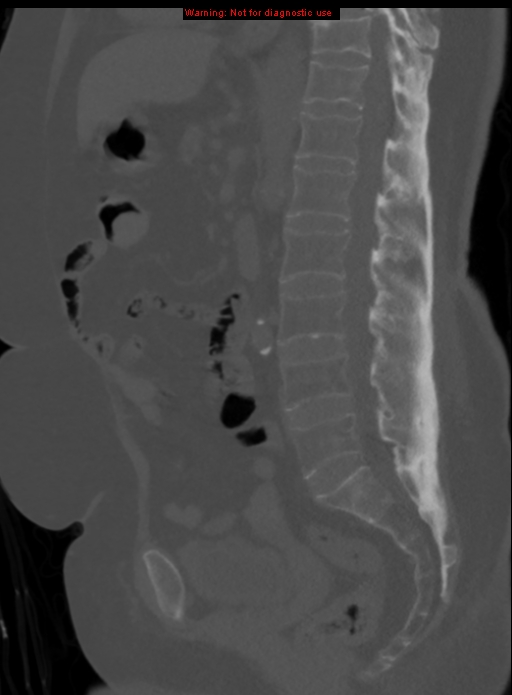 Ankylosing spondylitis - with dagger sign | Image | Radiopaedia.org