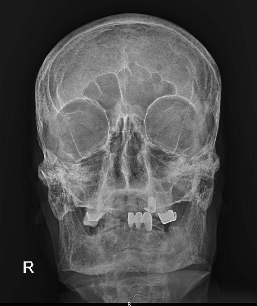 BONES Portrait X-ray Marker Parker for Radiology Technologist (multicolor  skull)