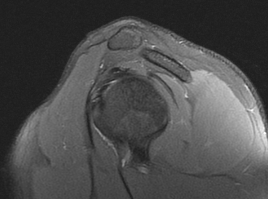 Coracoacromial ligament complete tear | Image | Radiopaedia.org