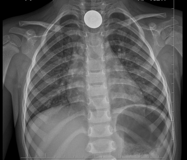 Ingested coin | Radiology Case | Radiopaedia.org