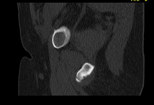 Ischial Tuberosity Avulsion Fracture Chronic Image 3209