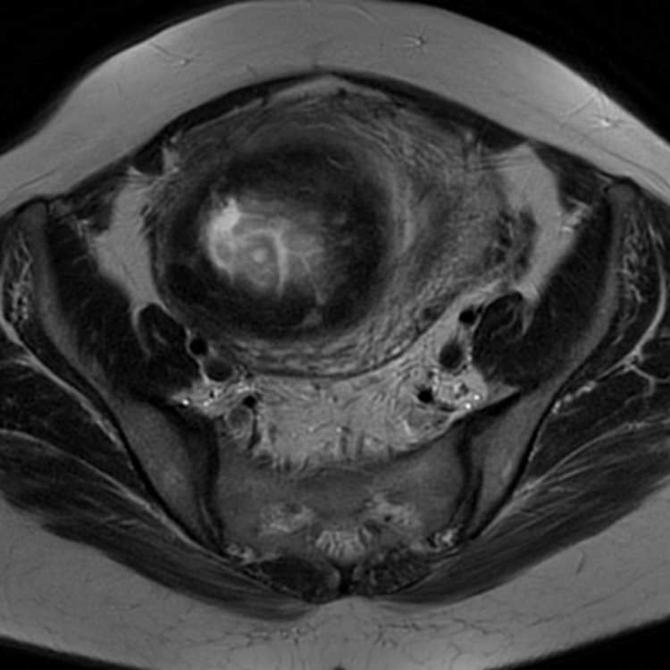 Uterine Leiomyoma With Red Degeneration | Image | Radiopaedia.org