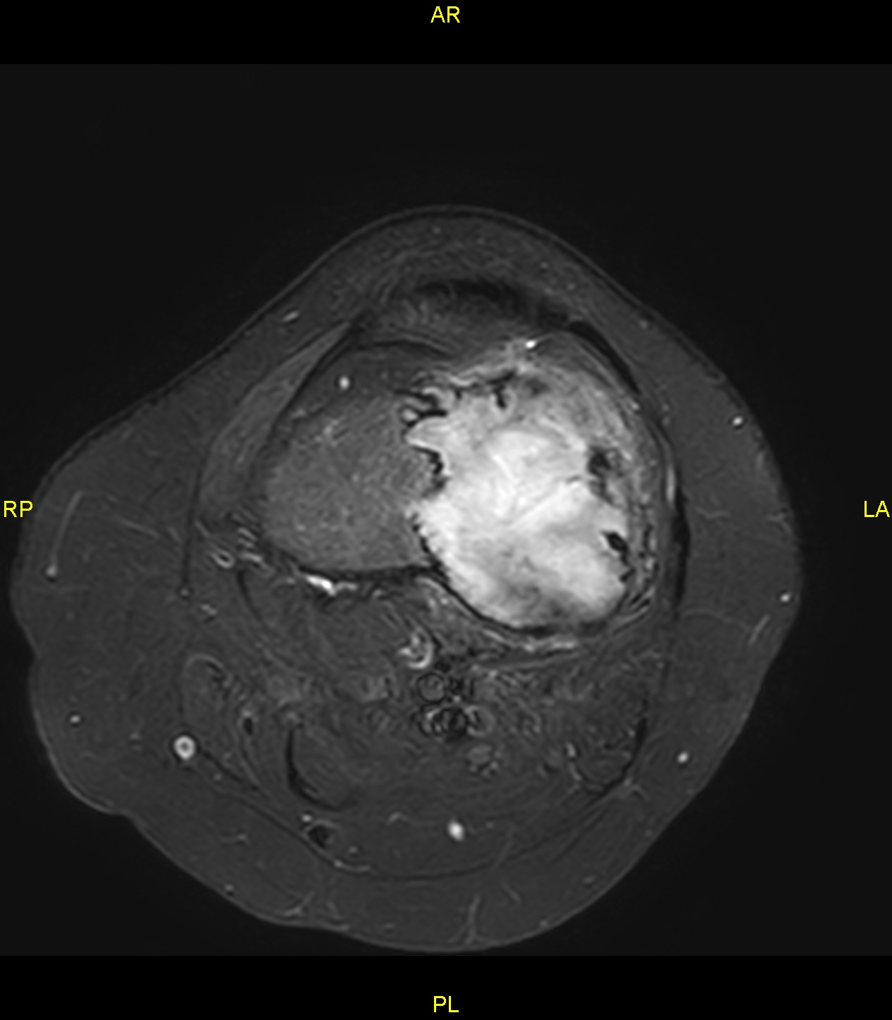 Non-ossifying fibroma (NOF) | Image | Radiopaedia.org