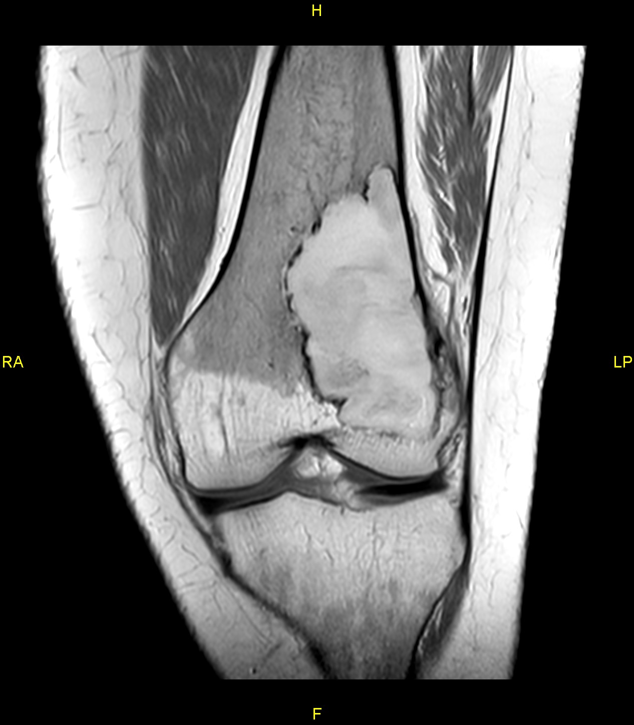 Non Ossifying Fibroma Nof Image