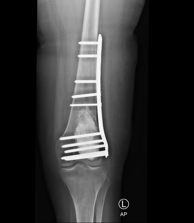 Non-ossifying fibroma (NOF) | Image | Radiopaedia.org