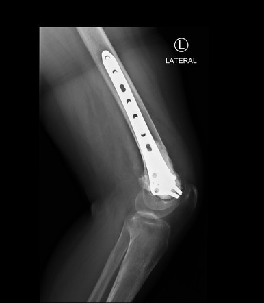 Non-ossifying fibroma (NOF) | Image | Radiopaedia.org