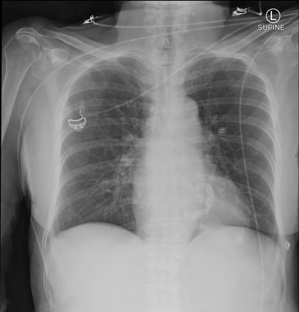 Left atrial enlargement | Radiology Case | Radiopaedia.org