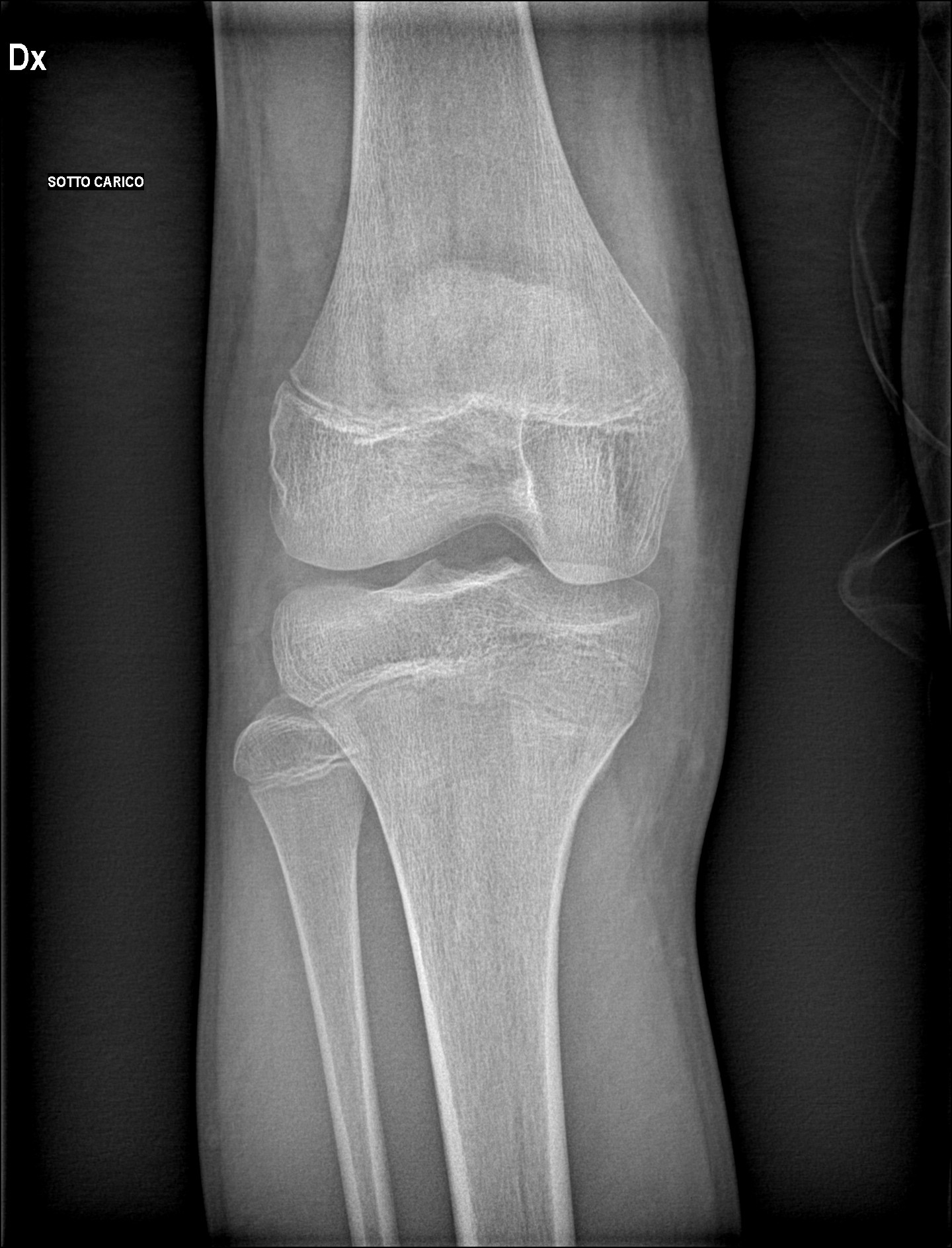 Chronic osteomyelitis with Brodie abscess Image Radiopaedia