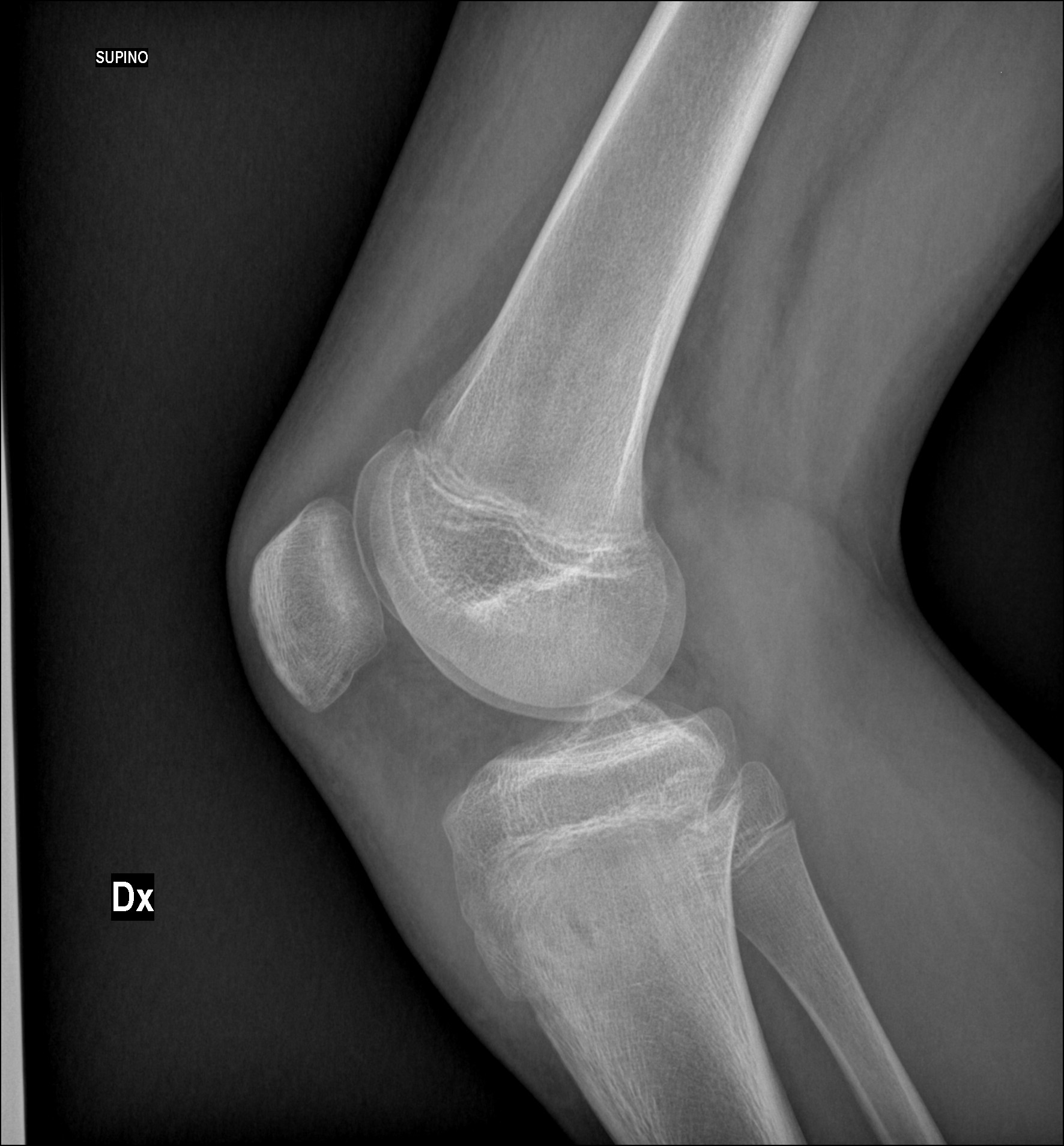 Chronic osteomyelitis with Brodie abscess Image Radiopaedia