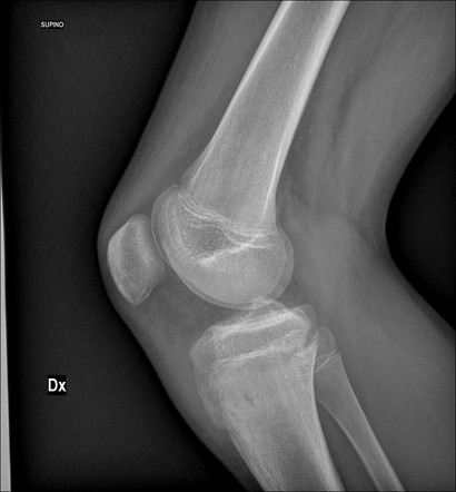 Chronic osteomyelitis - with Brodie abscess | Image | Radiopaedia.org