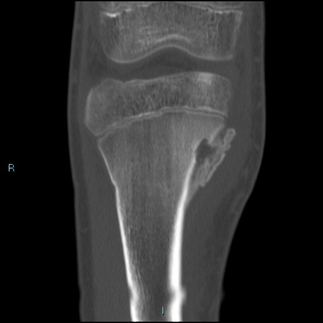 Brodie abscess Radiology Reference Article Radiopaedia